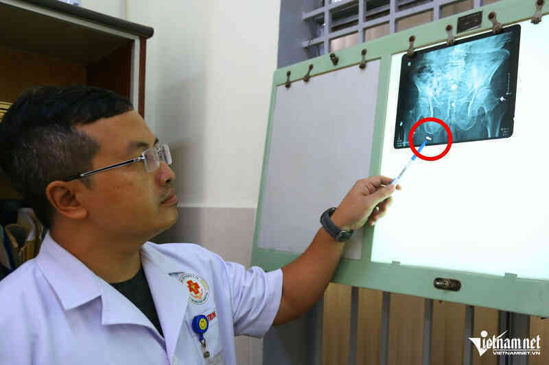 Bất ngờ tìm thấy dị vật `ngủ quên` hơn 6 thập kỷ trong người cụ ông