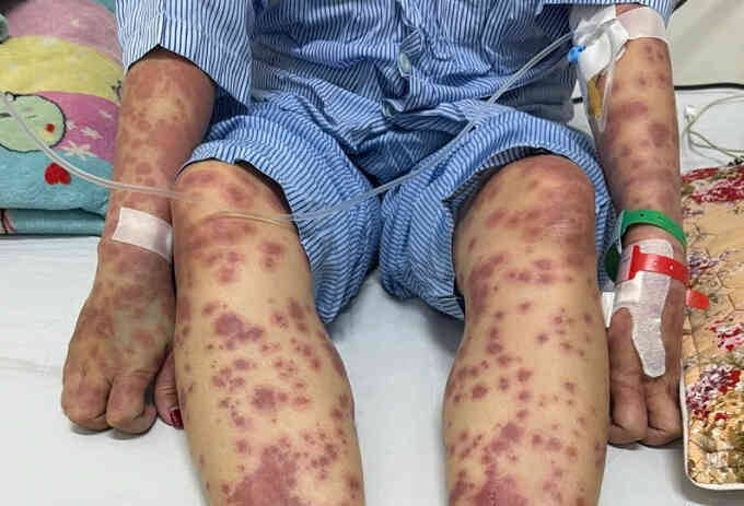 Dị ứng nặng sau uống viên giảm cân thải độc