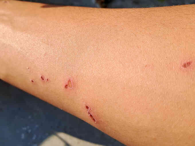 Đắp lá và uống thuốc nam có trị bệnh dại?