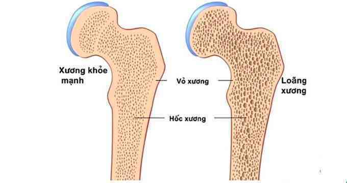 Loãng xương và cách phòng ngừa