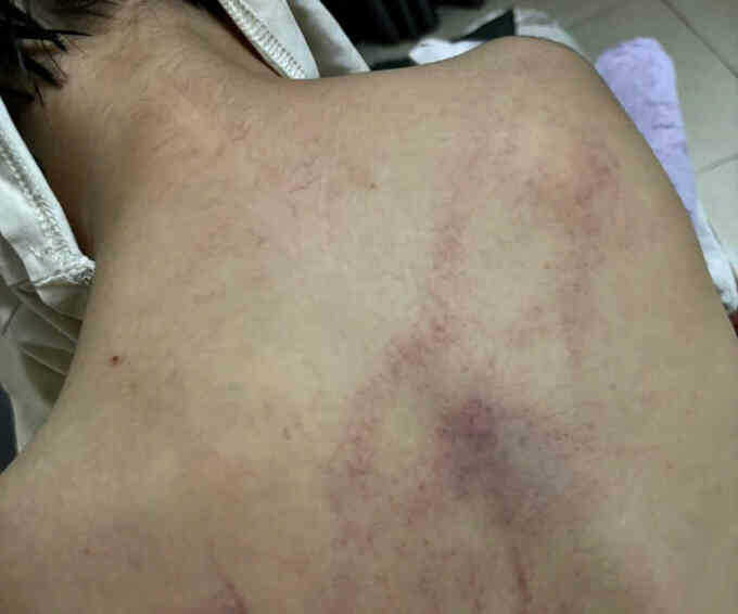 Bé 4 tuổi bị đánh tím lưng ở lớp