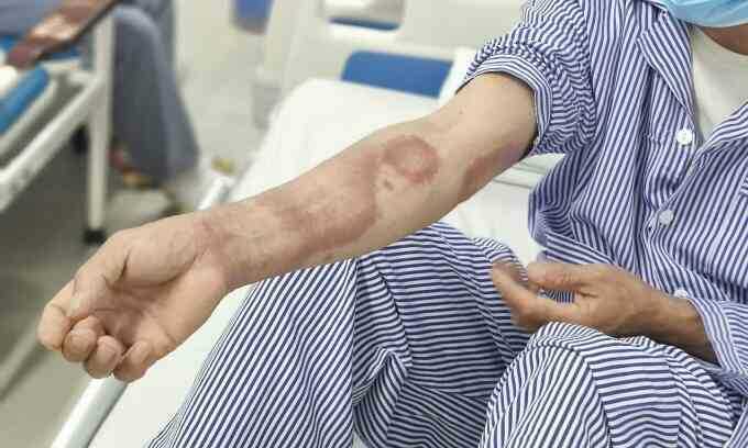 Bệnh phong âm thầm tấn công hai cha con