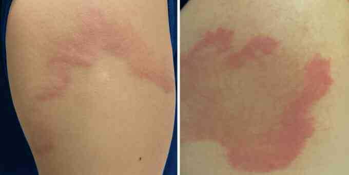 Dị ứng do mề đay mạn tính