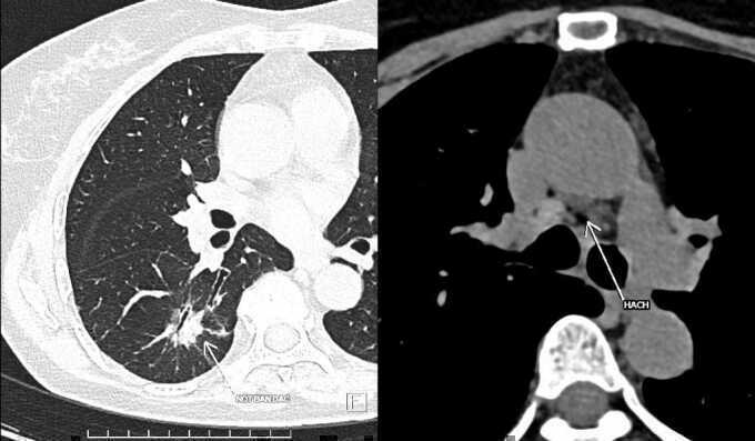 Cắt phổi triệt căn ung thư