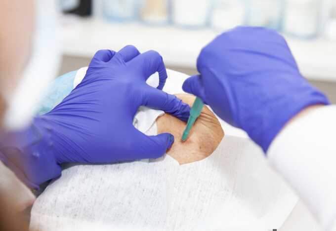 Sinh thiết khiến ung thư nặng hơn?