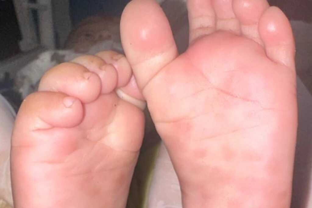 Bé trai 3 tuổi mắc giang mai bẩm sinh