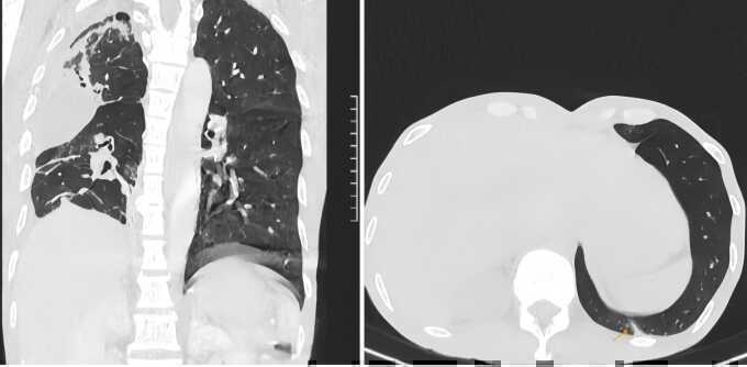 Phổi đông đặc do nấm lao
