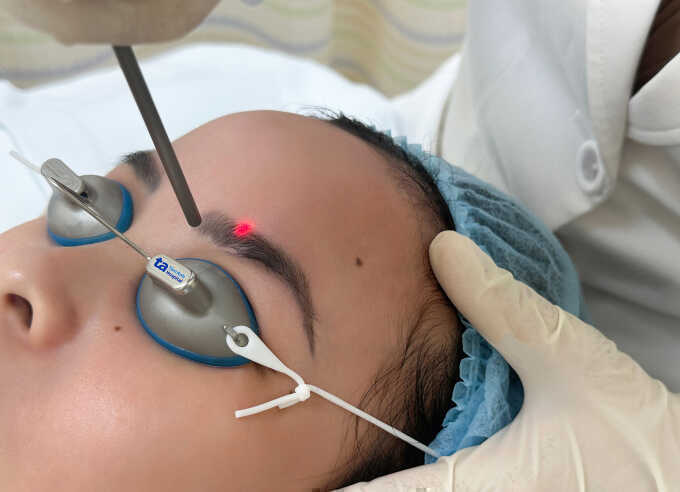 Xóa xăm mày có gây rụng lông không?