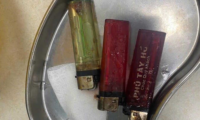 Gắp 3 chiếc bật lửa trong dạ dày người đàn ông