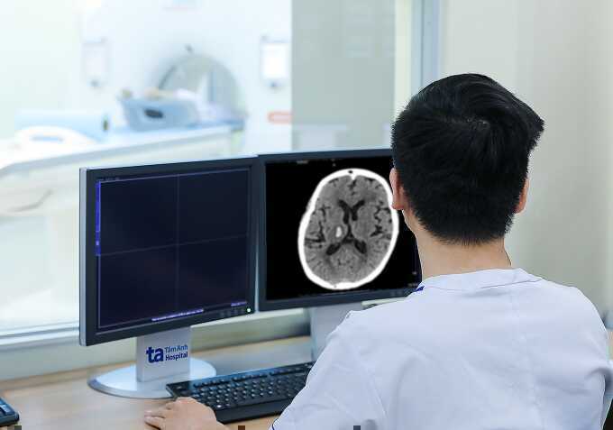Xuất huyết não do tăng huyết áp