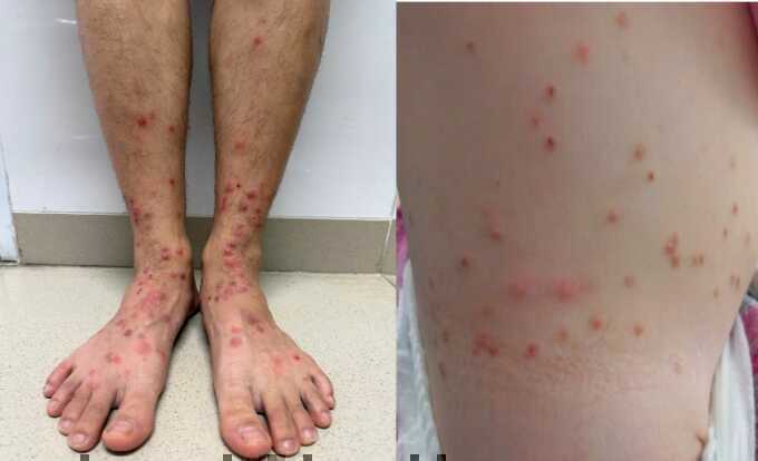 Nhiều người bị ngứa do bọ chét