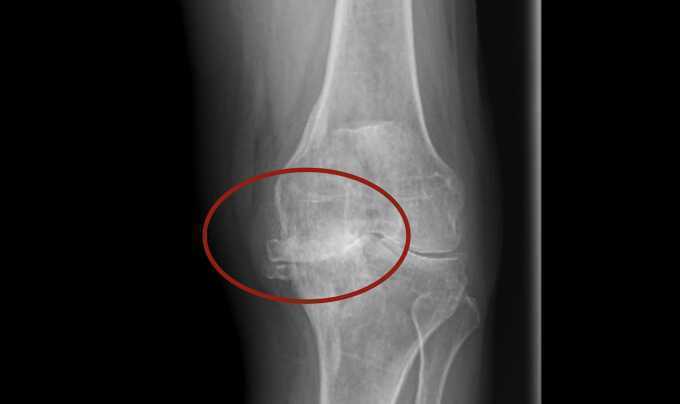 13 năm thoái hóa khớp gối