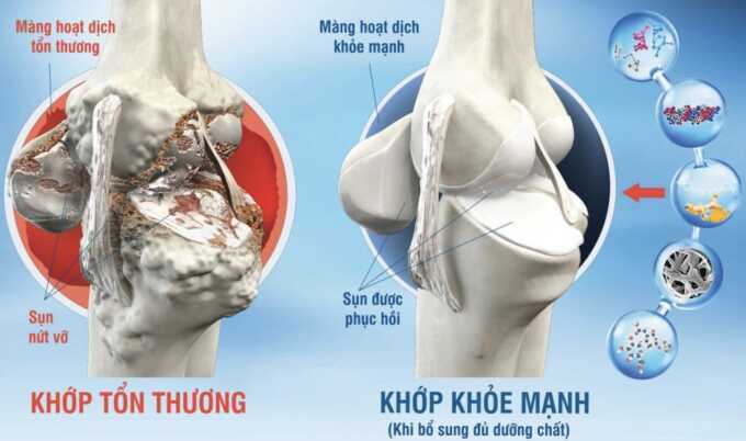 5 khớp trên cơ thể dễ bị thoái hóa
