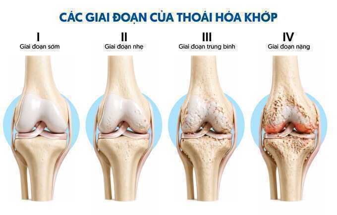 Điều gì xảy ra khi thoái hóa khớp?