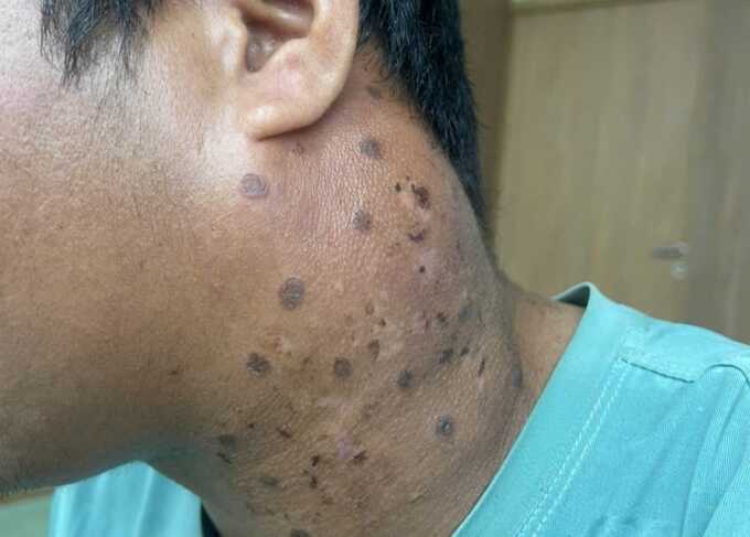 Tưởng cảm xoàng hóa ung thư giai đoạn cuối