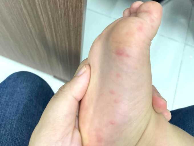 Nỗi lo con tái nhiễm tay chân miệng