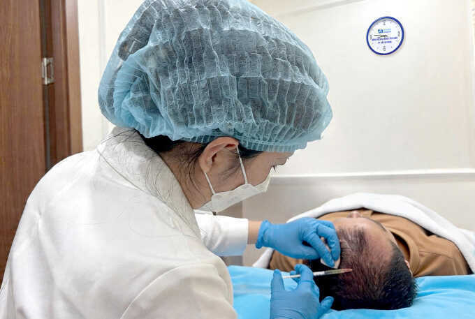 Hói đầu ở tuổi 19