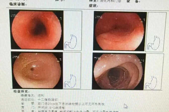 Người phụ nữ loét thực quản 8 cm vì nuốt vội thức ăn trong nồi lẩu
