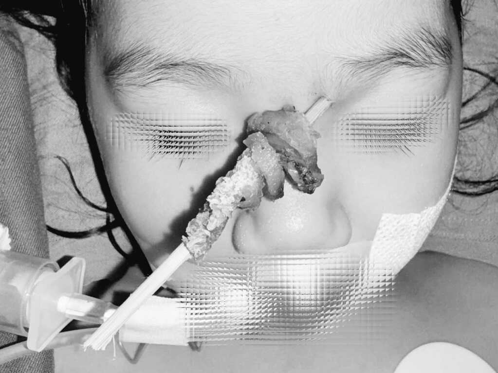 Bé gái gặp nạn khi ăn thịt xiên nướng, bác sĩ phải chuẩn bị tình huống xấu nhất