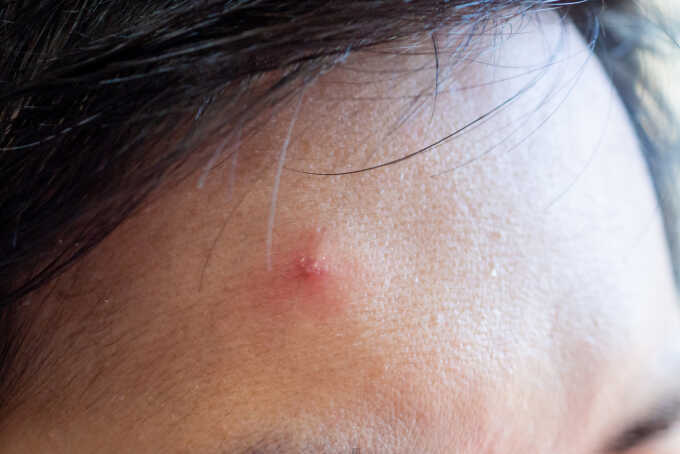 Mắc sùi mào gà ở trán, đầu