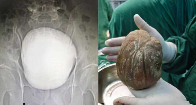Khối sỏi bàng quang 1,3 kg khiến người đàn ông tiểu buốt suốt 3 năm