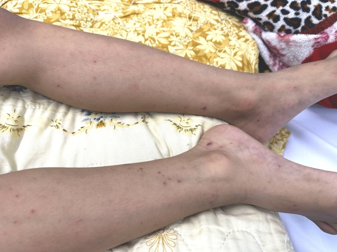 Đường lây nhiễm của não mô cầu