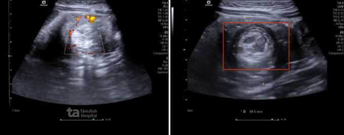 Bé trai 4 tuổi bị lồng ruột cấp