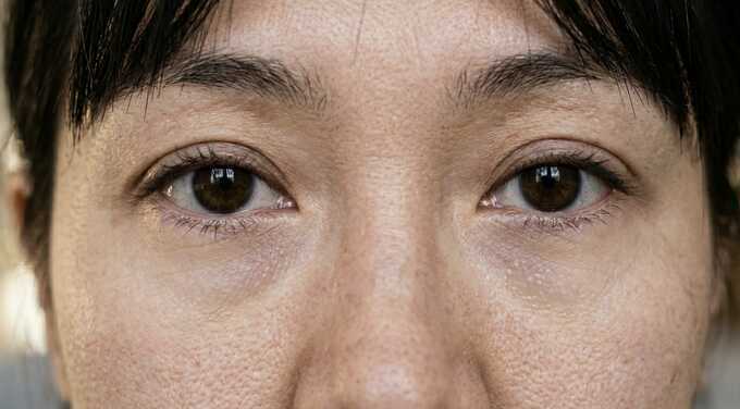 Nguyên nhân gây quầng thâm dưới mắt