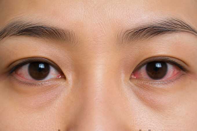 Mí mắt sụp một bên cảnh báo bệnh gì?