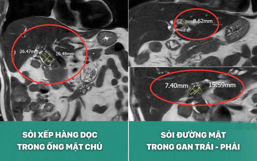 Chiến lược phẫu thuật an toàn cho bệnh nhân sỏi mật phức tạp tại BVĐK Hồng Ngọc