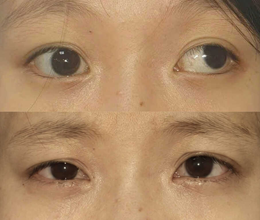 Hết lé sau phẫu thuật chỉnh lác