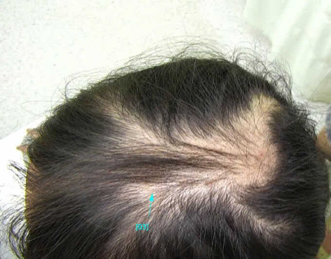 Bé gái mắc hội chứng nghiện giật tóc