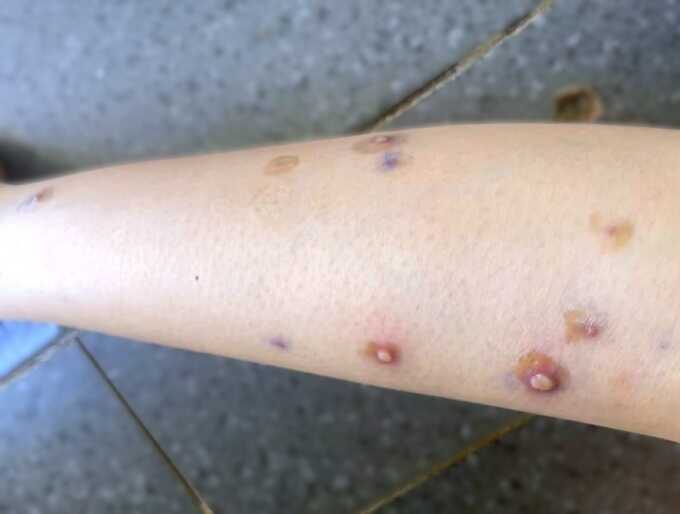 Lây chéo thủy đậu trong gia đình