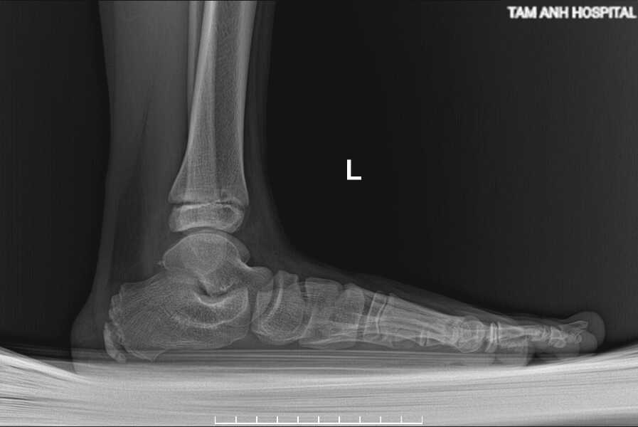 Cách điều trị bàn chân bẹt ở trẻ