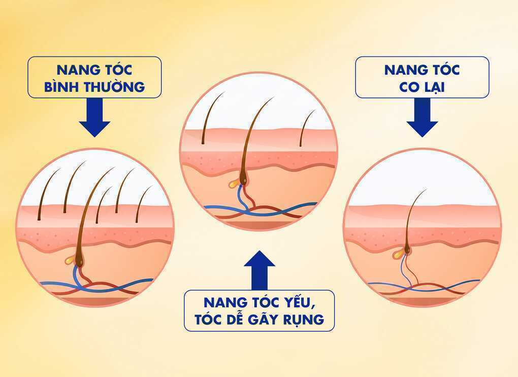 Nhuộm tóc có khiến tóc rụng nhiều hơn?