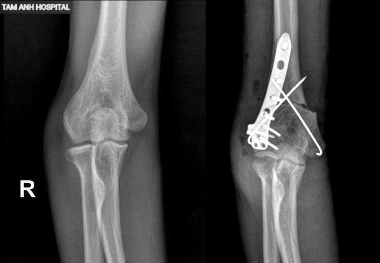 Phẫu thuật chỉnh sửa khuỷu tay 16 năm bị vẹo
